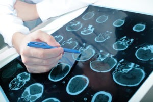 You cannot be physically functional with an incomplete form of locked-in syndrome. How Functional Can You Be With An Incomplete Form of Locked-In Syndrome?