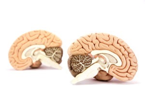 While a medical error can cause a brain stem stroke, most result from clots or hemorrhages. Can A Medical Mistake Lead To A Brain Stem Stroke?