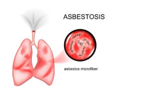Asbestosis is a lung disease caused by inhaling asbestos fibers. Asbestosis & Medical Malpractice Law