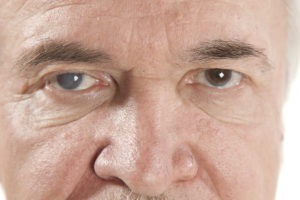 A cataract is a medical condition in which the lens of your eye becomes cloudy. Cataract & Medical Malpractice Law
